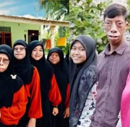 இந்தோனேசியா: அரிய நோயால் குடும்பமே பாதிப்பு; சமூக ஊடகம் வாயிலாக பிரபலம்