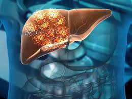 கல்லீரல் பாதிக்கப்பட்ட 2 நோயாளிகளின் மனைவிகளிடம் இருந்து தானம் பெற்ற கல்லீரல்களை பரஸ்பரம் மாற்றி பொருத்தி சிகிச்சை