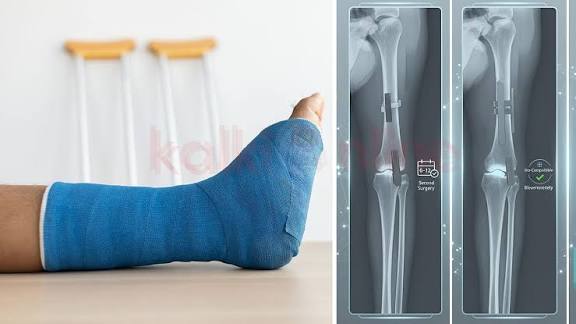 3 மாசத்துல கரைஞ்சு போகும் 'ரீசார்ஜபிள் பிளேட்' - எலும்பு முறிவை சரிசெய்யும் மேஜிக்!