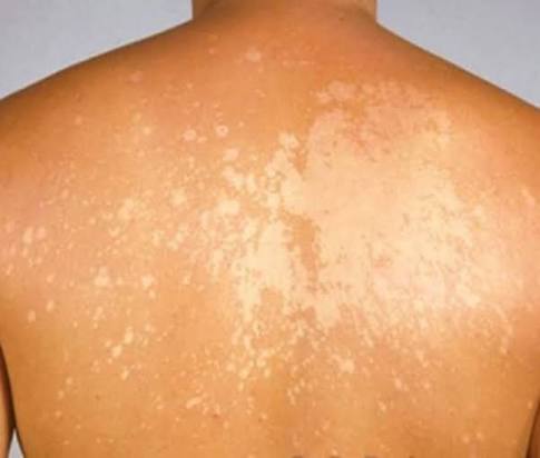 உடல் முழுவதும் தேமலா? இதோ டிப்ஸ்!!!