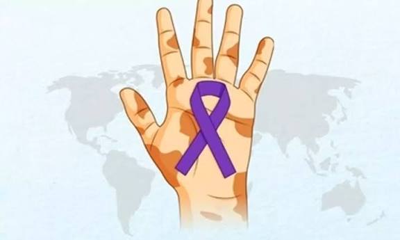 தொழுநோய் ஒழிப்போம்